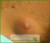 Cysts Removal