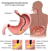 gastroscopy-image