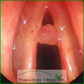 Vocal Cord Growth