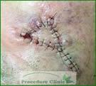 Flap - After Surgery - Skin Cancer