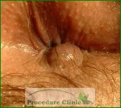 Small Lump Inside Anal Canal 22